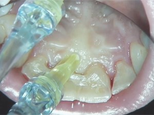 Online Dental CE Webinars And Events | Video - null | DentalXP