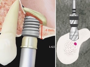 Online Dental CE Webinars And Events | Video - null | DentalXP