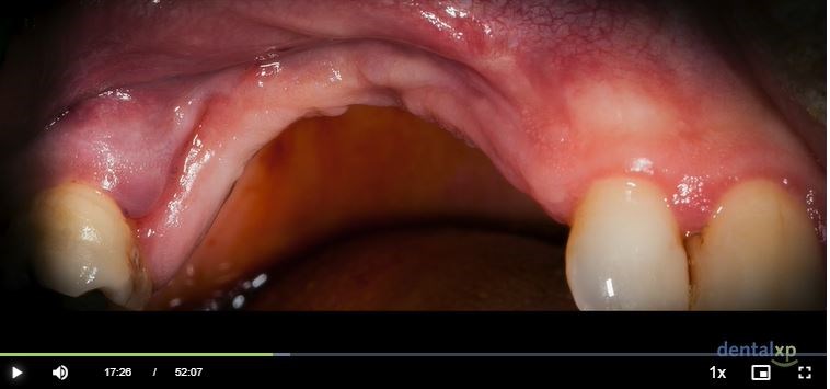 Online Dental CE Webinars And Events | Video - null | DentalXP